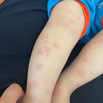 Bebe Bisküvisi Sonrası Alerjik Reaksiyon Ve Katkı Maddesi Endişesi