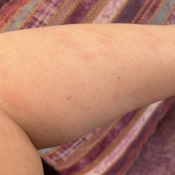 IPL Cihazı Yanık Oluşturdu, İade Talebim Reddedildi