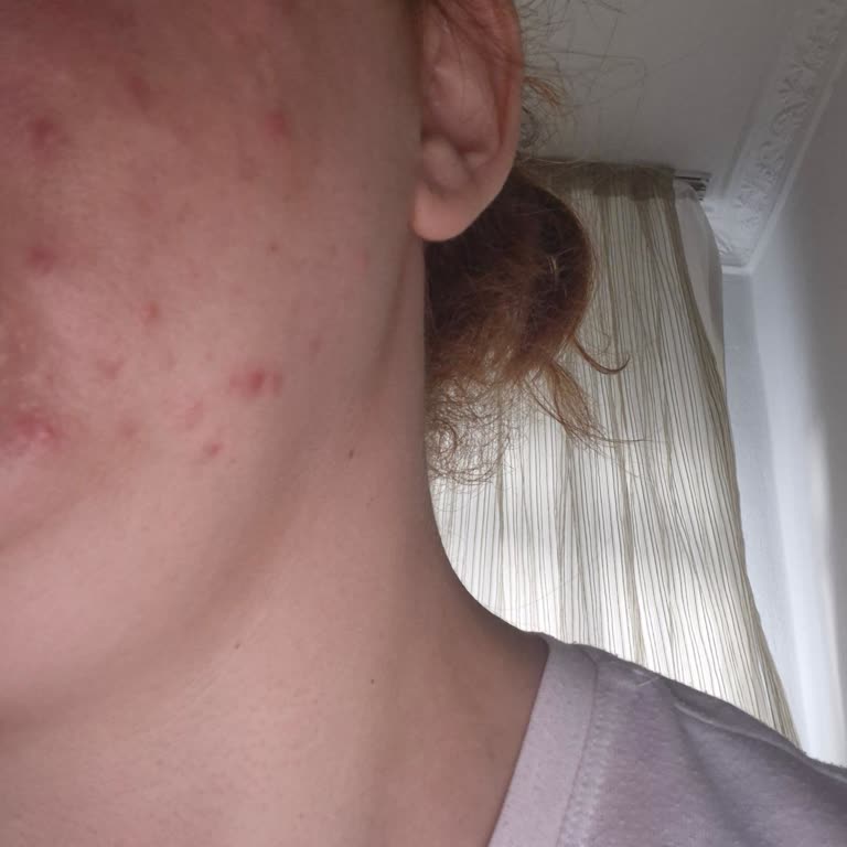 Nivea Ürünleri Sonrası Cildimde Ciddi Sivilce Ve Kızarıklık Sorunu Yaşadım