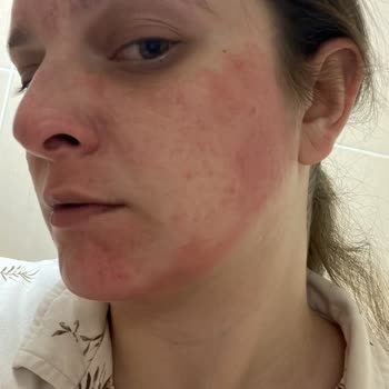 Kil Maskesi Sonrası Cildimde Beklenmedik Tahriş Ve Kızarıklık