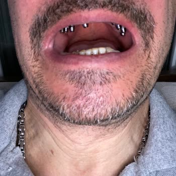 Eksik Ve Kusurlu Diş Protezi Nedeniyle Tedavi Tamamlanamadı, Ücret İadesi Talebi