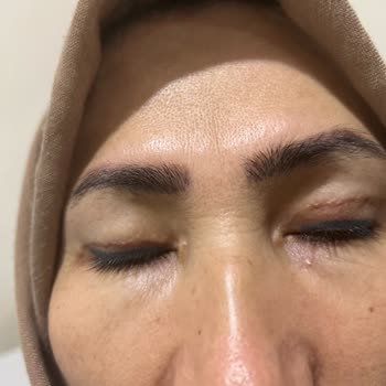 Blefaroplasti Ameliyatı Sonrası Olumsuz Sonuçlar Ve Faturasız İşlem