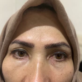 Blefaroplasti Ameliyatı Sonrası Olumsuz Sonuçlar Ve Faturasız İşlem