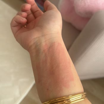 ABC Bulaşık Deterjanı Cildimde Tahriş Ve Kurdeşen Yaptı Uyarı Yoktu