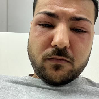 Lazer Epilasyon Sonrası Alerji Ve Kullanılmayan Seans Ücretinin İade Edilmemesi