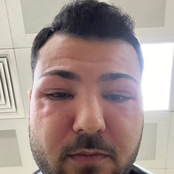 Lazer Epilasyon Sonrası Alerji Ve Kullanılmayan Seans Ücretinin İade Edilmemesi