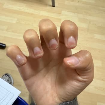 Protez Tırnak Çıkartma Sonrası Sağlık Sorunu Ve İlgisizlik