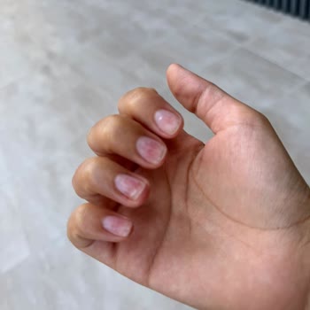 Protez Tırnak Çıkartma Sonrası Sağlık Sorunu Ve İlgisizlik