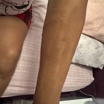 Lazer Cihazı Yanıkları Ve Markadan Destek Alamama