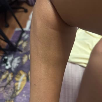 Lazer Cihazı Yanıkları Ve Markadan Destek Alamama