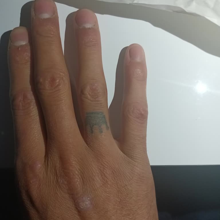 Küçük Dövme Nedeniyle Sınavdan Elenme Mağduriyeti