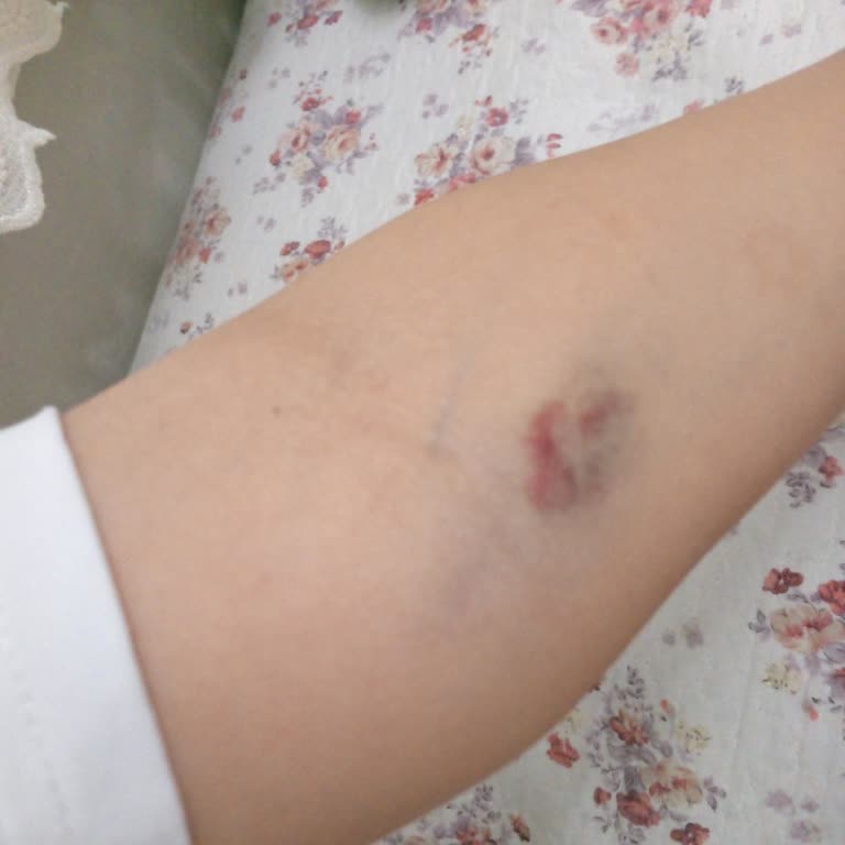 Kan Alma Sırasında Yaşanan Morluklar Ve Fazla Tüp Alınması Mağduriyet Yarattı