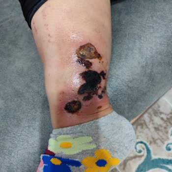 Gülağaç Devlet Hastanesi Doktorun Yanlış Krem Reçete Etmesi