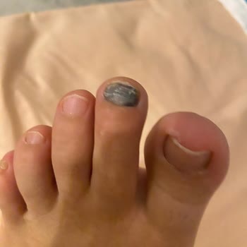 Yeni Alınan Ayakkabı Ayağımı Morarttı, İade Talebime Dönüş Yapılmıyor