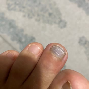 Yeni Alınan Ayakkabı Ayağımı Morarttı, İade Talebime Dönüş Yapılmıyor