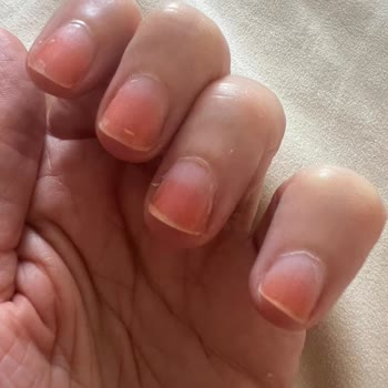 Flormar Oje Sonrası Sağlık Sorunu Ve İlgisizlik