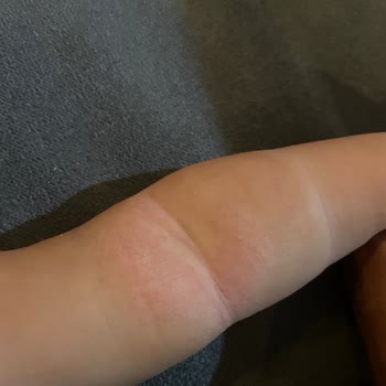 I Face Skin Irritation on My Baby After Using Mustela Stelatopia and Hydra Bébé