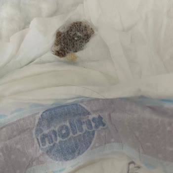 Bebek Bezinde Leke Sorunu Ve Hayati Risk Endişesi