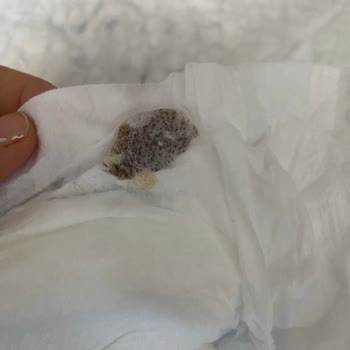 Bebek Bezinde Leke Sorunu Ve Hayati Risk Endişesi