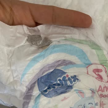 Bebek Bezinde Leke Sorunu Ve Hayati Risk Endişesi