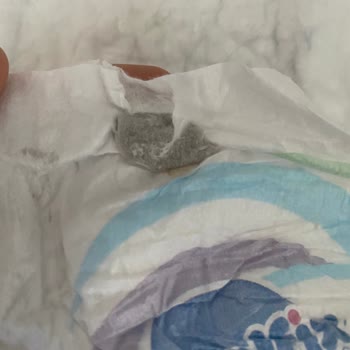 Bebek Bezinde Leke Sorunu Ve Hayati Risk Endişesi