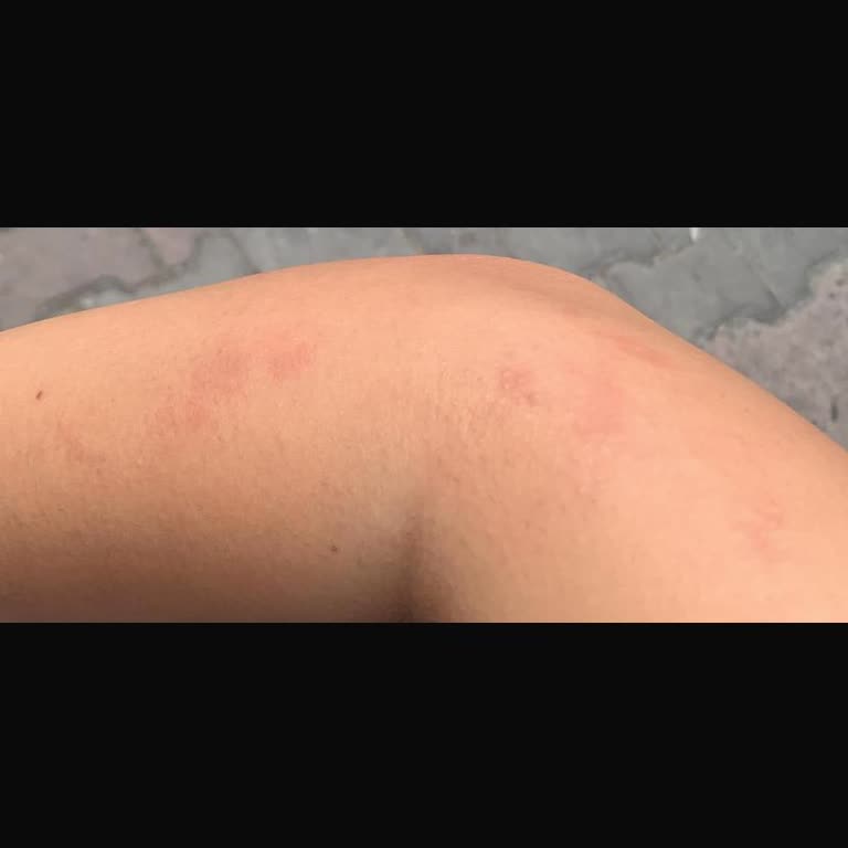 Lazer Epilasyon Sonrası Yanık Ve Randevu Mağduriyeti