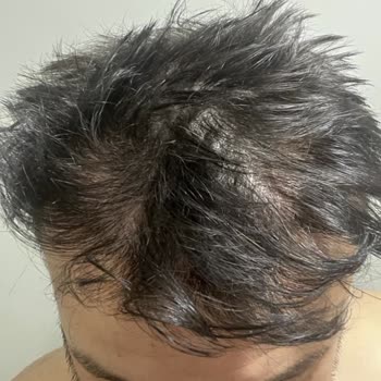 Saç Ekimi Sonrası Seyrelme Ve Memnuniyetsizlik: Ücretsiz Düzeltme Talebi