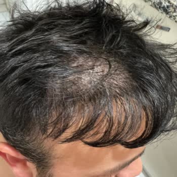 Saç Ekimi Sonrası Seyrelme Ve Memnuniyetsizlik: Ücretsiz Düzeltme Talebi