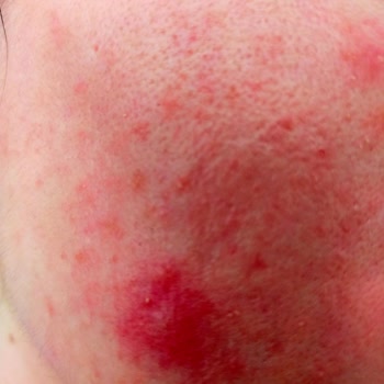 I Face Severe Skin Damage and Infection From Garnier Vitamin C Face Wash