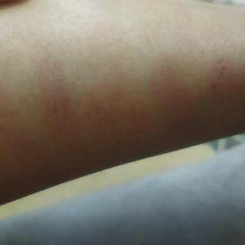 Zülal Göçmen Beauty Lounge Oluşan İzlerle İlgilenmedi