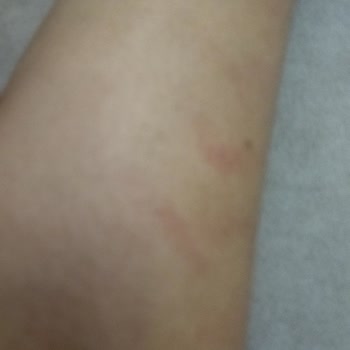 Zülal Göçmen Beauty Lounge Oluşan İzlerle İlgilenmedi