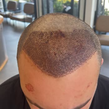 Saç Ekimi Sonrası Yüzde Kalıcı İz Ve Yetersiz Çözüm Önerisi