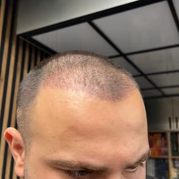 Saç Ekimi Sonrası Yüzde Kalıcı İz Ve Yetersiz Çözüm Önerisi