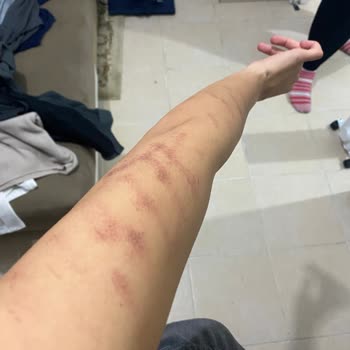 Lazer Epilasyon Sonrası Kalıcı Yanık Ve İlgisizlik Nedeniyle Mağduriyet