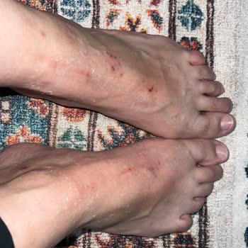 Ayak Maskesi Kullanımı Sonrası Ciltte Tahriş Ve Yanma