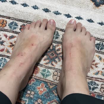 Ayak Maskesi Kullanımı Sonrası Ciltte Tahriş Ve Yanma