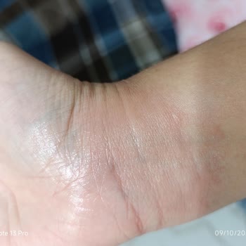 Fairy Bulaşık Deterjanı Sonrası Ciddi Alerjik Reaksiyon Ve Sağlık Endişesi
