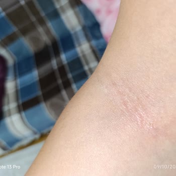 Fairy Bulaşık Deterjanı Sonrası Ciddi Alerjik Reaksiyon Ve Sağlık Endişesi