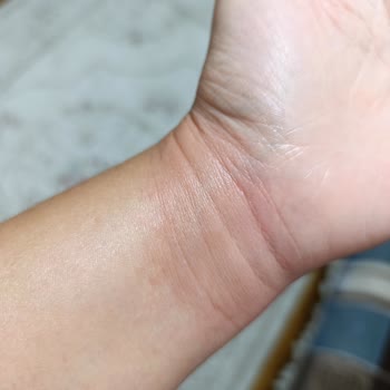Fairy Bulaşık Deterjanı Sonrası Ciddi Alerjik Reaksiyon Ve Sağlık Endişesi