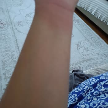 Fairy Bulaşık Deterjanı Sonrası Ciddi Alerjik Reaksiyon Ve Sağlık Endişesi