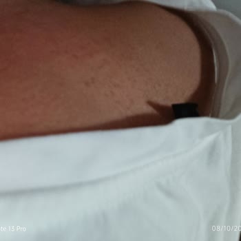 Fairy Bulaşık Deterjanı Sonrası Ciddi Alerjik Reaksiyon Ve Sağlık Endişesi