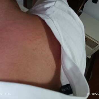 Fairy Bulaşık Deterjanı Sonrası Ciddi Alerjik Reaksiyon Ve Sağlık Endişesi