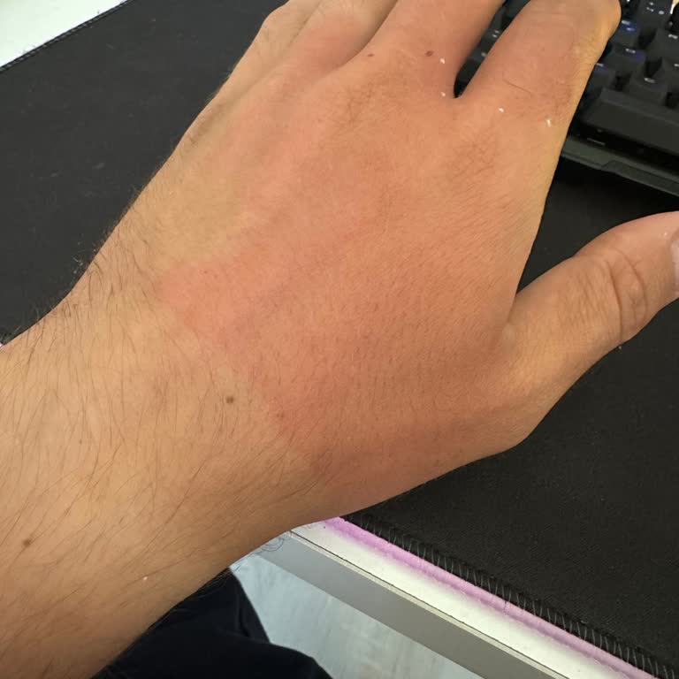 Stanley Termos Elimde Patladı Ve Yanık Oluştu