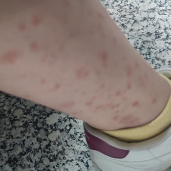 Niobe Pharma Artcare Kolajen Alerji Yaptı