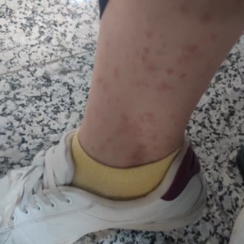 Niobe Pharma Artcare Kolajen Alerji Yaptı