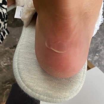 Yüksek Fiyatlı Ayakkabıda Kısa Sürede Ciddi Hasar Ve Mağduriyet