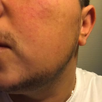 Vaseline Gluta-Hya Ürünü İlk Kullanımda Cildimde Kalıcı Kızarıklık Yaptı