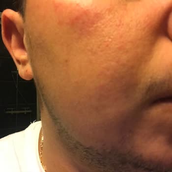 Vaseline Gluta-Hya Ürünü İlk Kullanımda Cildimde Kalıcı Kızarıklık Yaptı