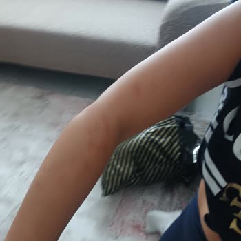 Güzellik Salonu Hizmetinde Randevu Gecikmesi ve Lazer Epilasyon Sonrası Yanık Şikayeti