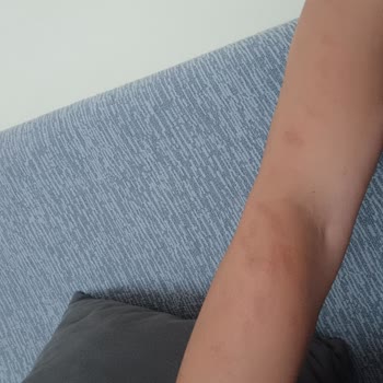 Güzellik Salonu Hizmetinde Randevu Gecikmesi ve Lazer Epilasyon Sonrası Yanık Şikayeti